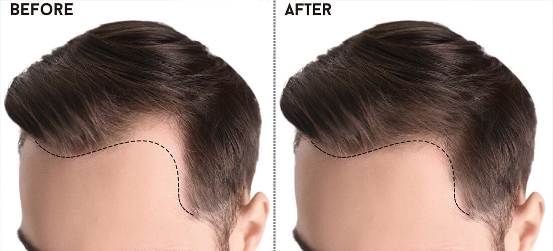 Unlocking Confidence: A Comprehensive Guide to Finding the Best Hair Transplant in Islamabad