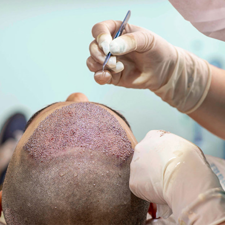 Hair Transplant Surgeon