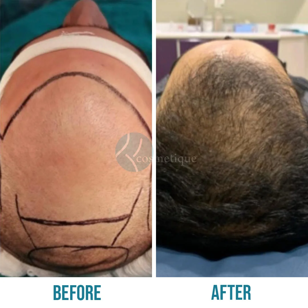 best hair transplant in pakistan