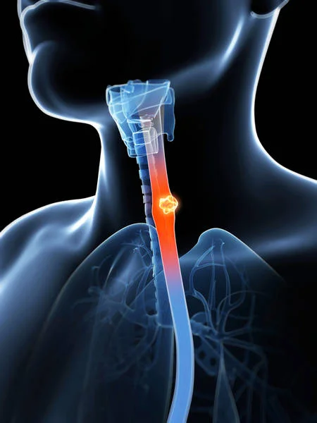 esophageal cancer best treatment