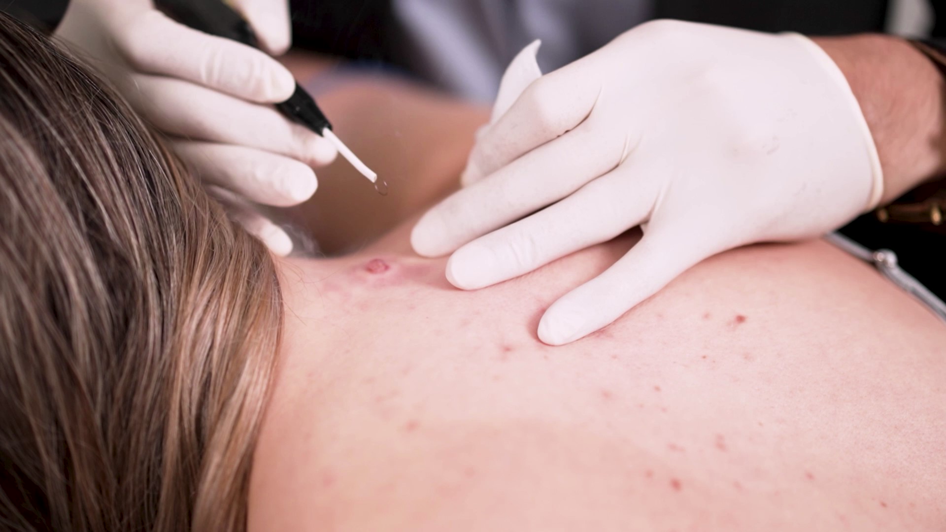 Say Goodbye to Moles: Sydney’s Best Mole Removal Treatments