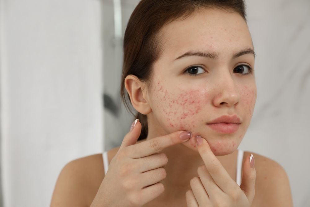 Understanding the Role of Hormone Therapy in Acne Management in Dubai