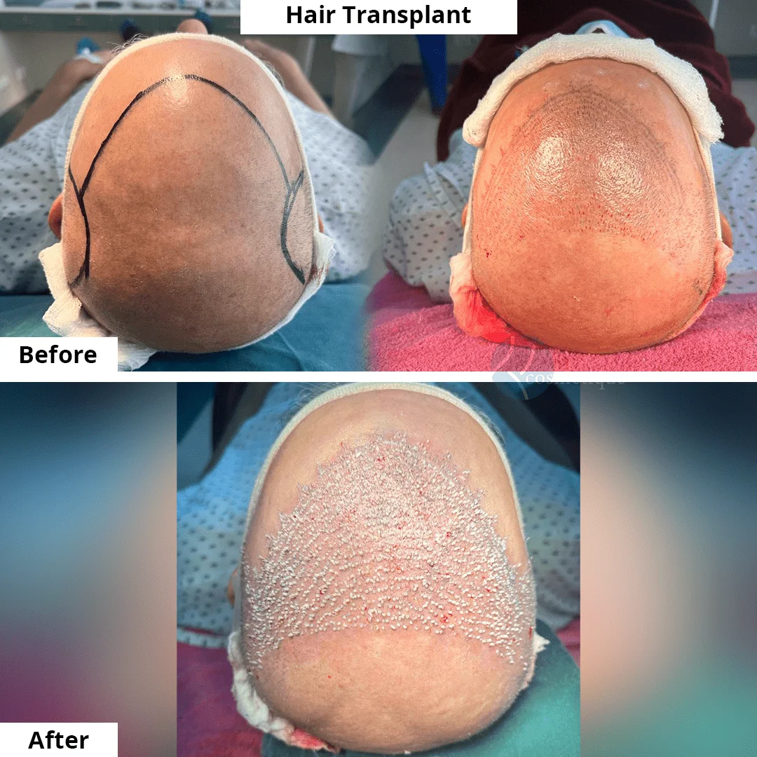 best hair transplant in lahore