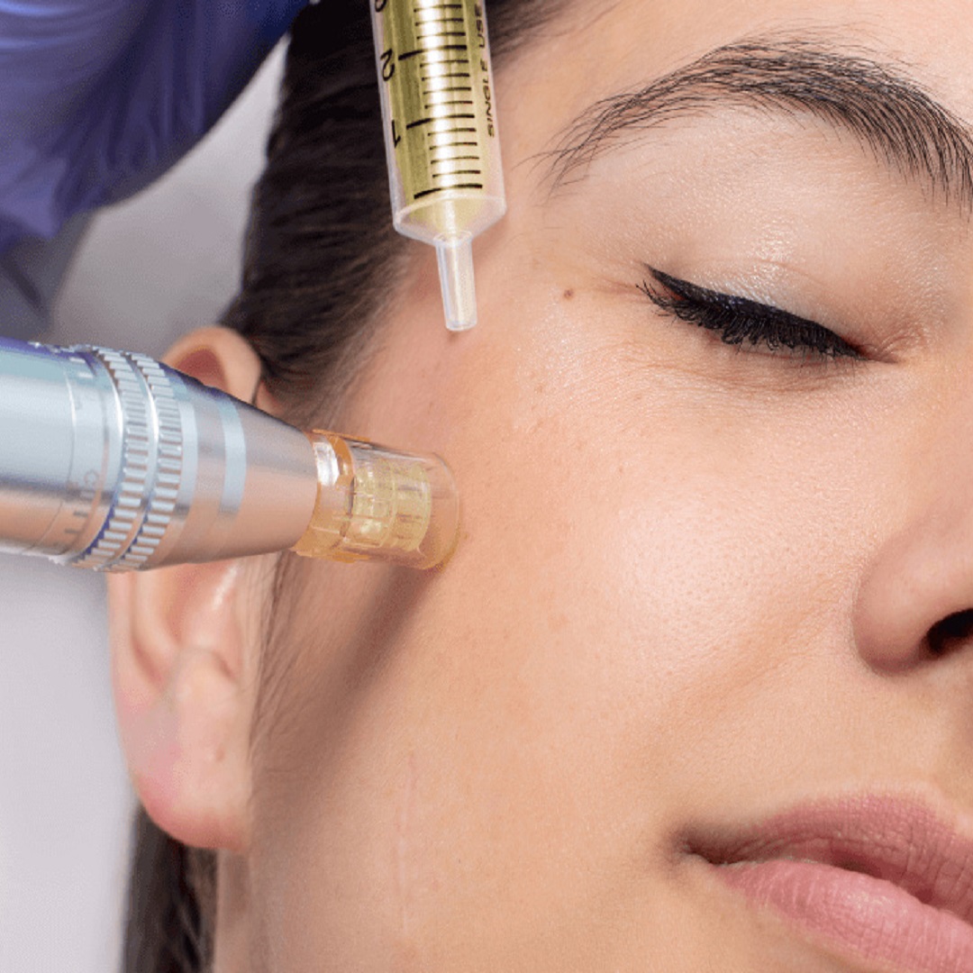 Achieve a Flawless Complexion with Plasma Pen Treatment