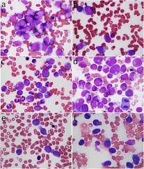 causes of Philadelphia Chromosome