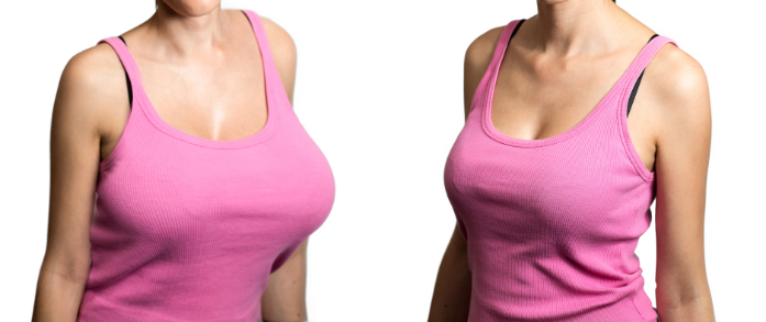 Why Indian Women Are Turning to Breast Reduction Surgery in 2024