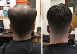 hair patch for men toronto