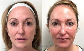 Why the Ultrapulse CO2 Laser in London is Your Best Option for Youthful Skin